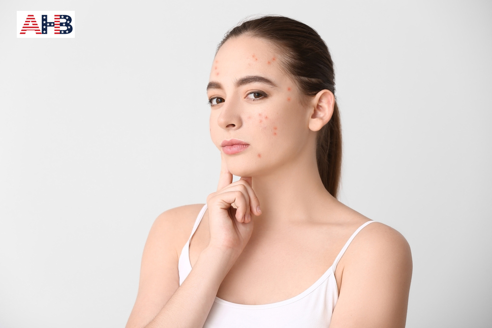Phương pháp trị mụn chuẩn y khoa